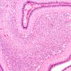 6E2 N Hypoxia ischemia (Case 6) Slide E H&E 10X