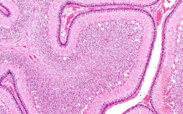 6E2 N Hypoxia ischemia (Case 6) Slide E H&E 10X