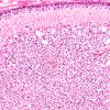 6E3 N Hypoxia ischemia (Case 6) Slide E H&E 20X copy