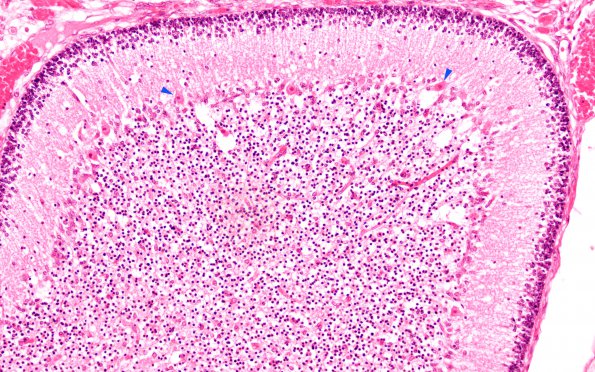 6E3 N Hypoxia ischemia (Case 6) Slide E H&E 20X copy