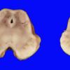 7A1 Hypoxia, 2 wk after CPA (Case 7) _7