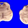 7A2 Hypoxia, 2 wk after CPA (Case 7) _8