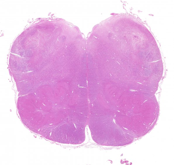 8A1 Hypoxia-Ischemia (Case 8) H&E WM A1