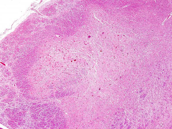 8A2 AHypoxia-Ischemia (Case 8) medulla H&E 1.