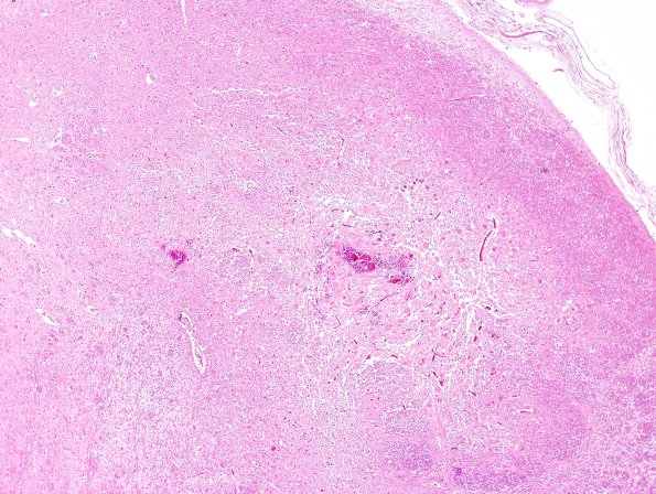 8A3 Hypoxia-Ischemia (Case 8) medulla H&E 2