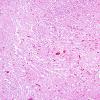 8A4 Hypoxia-Ischemia (Case 8) medulla H&E 4A