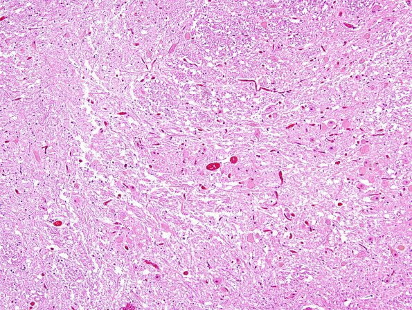 8A4 Hypoxia-Ischemia (Case 8) medulla H&E 4A