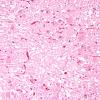 8A5 Hypoxia-Ischemia (Case 8) medulla H&E 5A