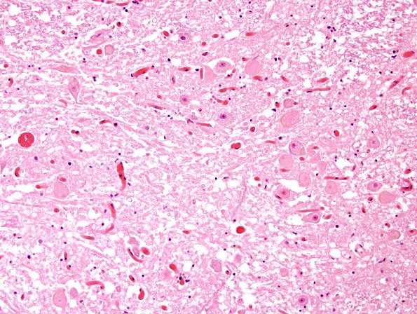 8A5 Hypoxia-Ischemia (Case 8) medulla H&E 5A