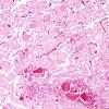 8A6 Hypoxia-Ischemia (Case 8) medulla H&E 6A