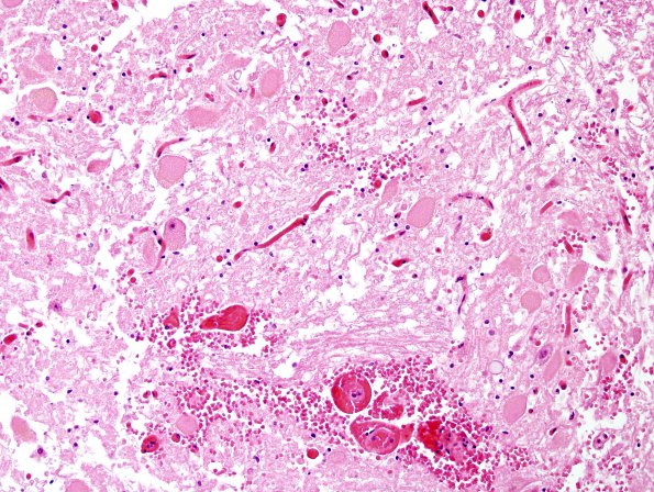 8A6 Hypoxia-Ischemia (Case 8) medulla H&E 6A