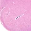 9A1 Hypoxia-ischemia, adult, ION (Case 9) H&E 6