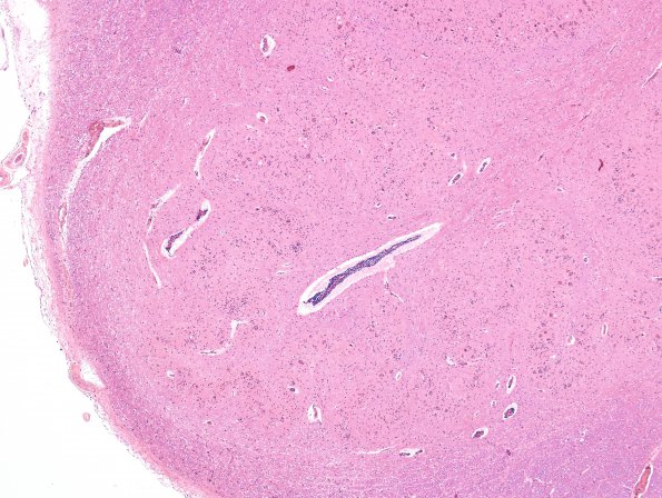 9A1 Hypoxia-ischemia, adult, ION (Case 9) H&E 6