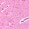 9A2 Hypoxia-ischemia, adult, ION (Case 9) H&E 2A