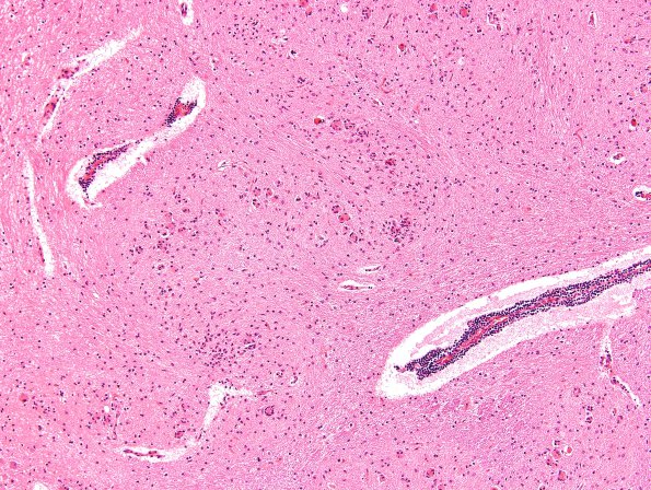 9A2 Hypoxia-ischemia, adult, ION (Case 9) H&E 2A