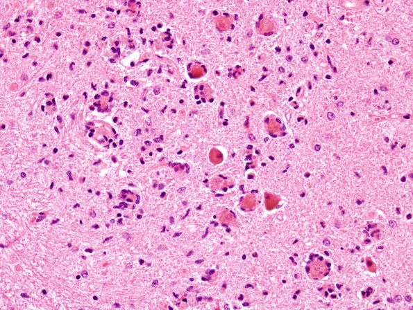 9A3 Hypoxia-ischemia, adult, ION (Case 9) H&E 1