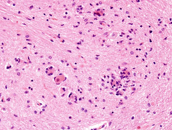 9A4 Hypoxia-ischemia, adult, ION (Case 9) H&E 4