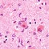 9A5 Hypoxia-ischemia, adult, ION (Case 9) H&E 3