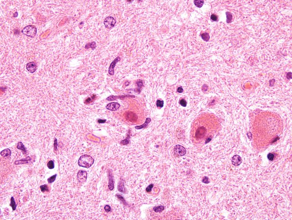 9A5 Hypoxia-ischemia, adult, ION (Case 9) H&E 3