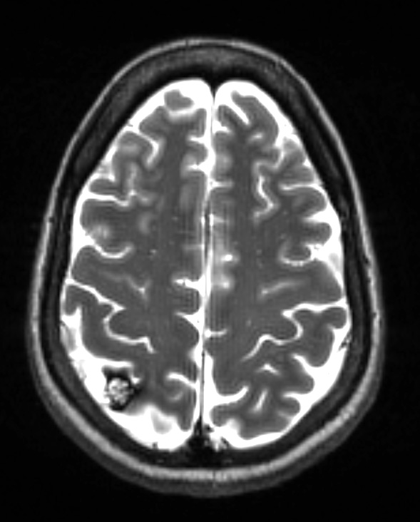 10A1 Cavernoma (Case 10) T2 with contrast - Copy