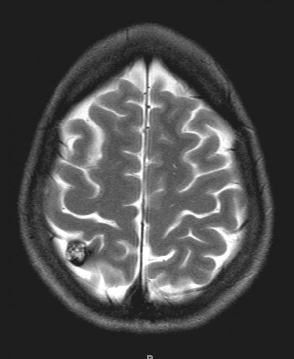 10A2 Cavernoma (Case 10) T2 without contrast - Copy