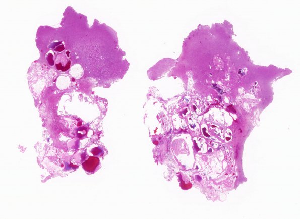 10B1 Cavernous angioma (Case 10) H&E whole mount