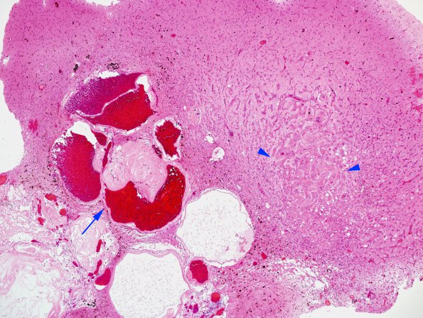 10B2 Cavernous angioma (Case 10) H&E 9 copy