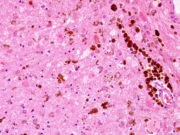 10B4 Cavernous angioma (Case 10) H&E 1