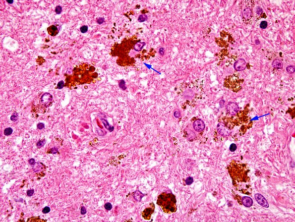 10B5 Cavernous angioma (Case 10) H&E 44 copy