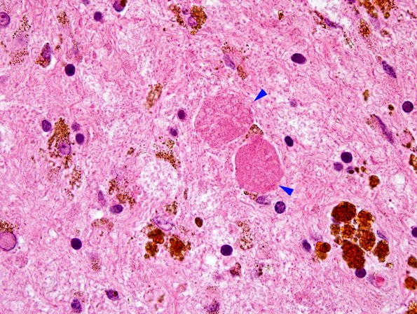 10B6 Cavernous angioma (Case 10) H&E 45 copy