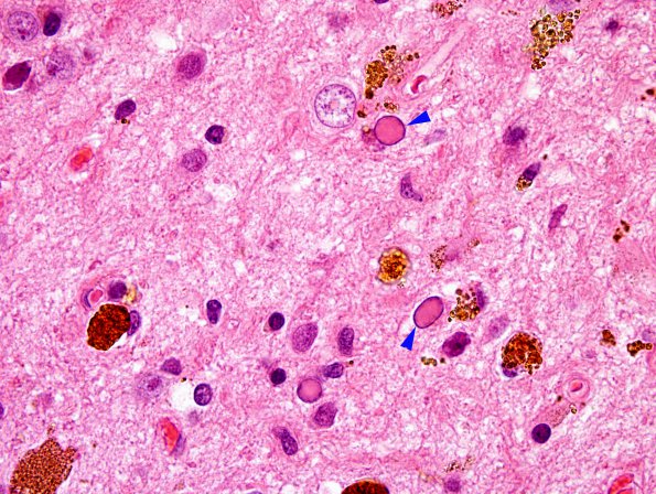 10B7 Cavernous angioma (Case 10) H&E 36 copy.
