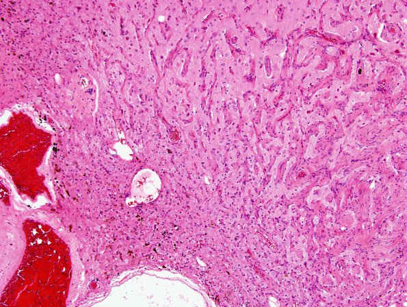 10C1 Cavernous angioma (Case 10) H&E 16