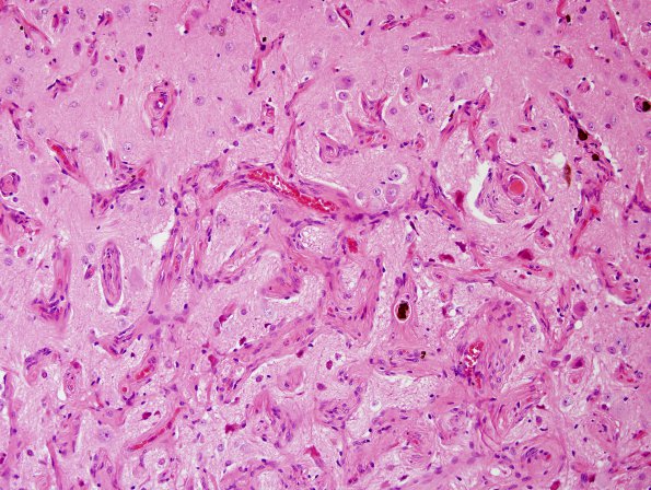 10C2 Cavernous angioma (Case 10) H&E 17