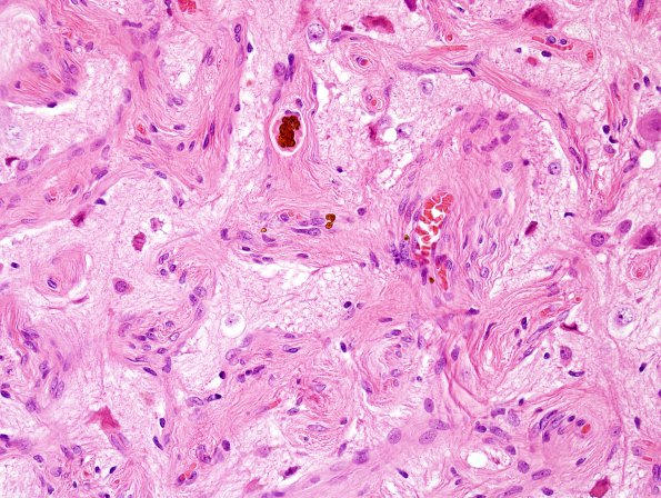 10C3 Cavernous angioma (Case 10) H&E 11