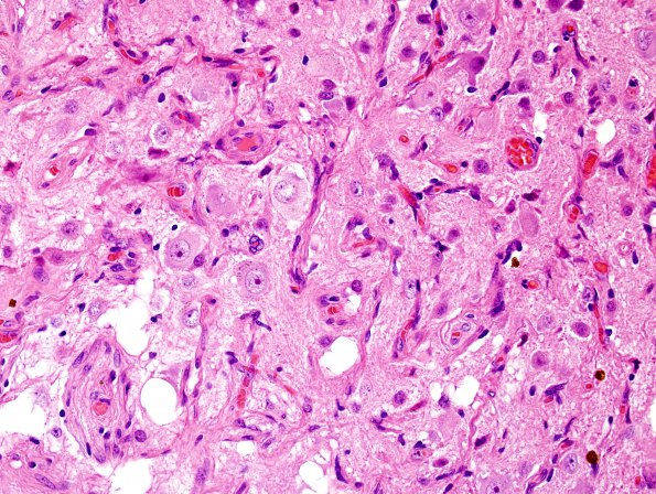10C4 Cavernous angioma (Case 10) H&E 14