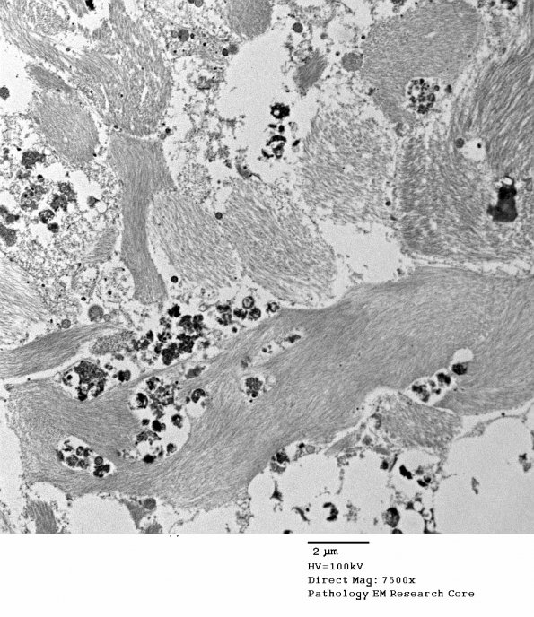 10D1 Cavernoma (Case 10) EM 006 - Copy