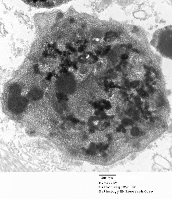10D3 Cavernoma, hemosiderin (Case 10) EM 011 - Copy