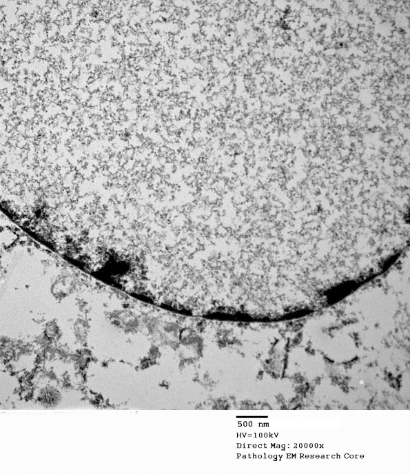 10D5 Cavernoma (Case 10)_051 - Copy