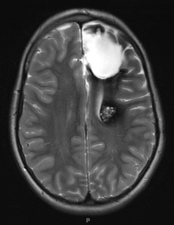 11A1 Cavernoma (Case 11) T2 no contrast - Copy