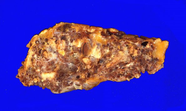 11B Cavernous angioma (Case 11)