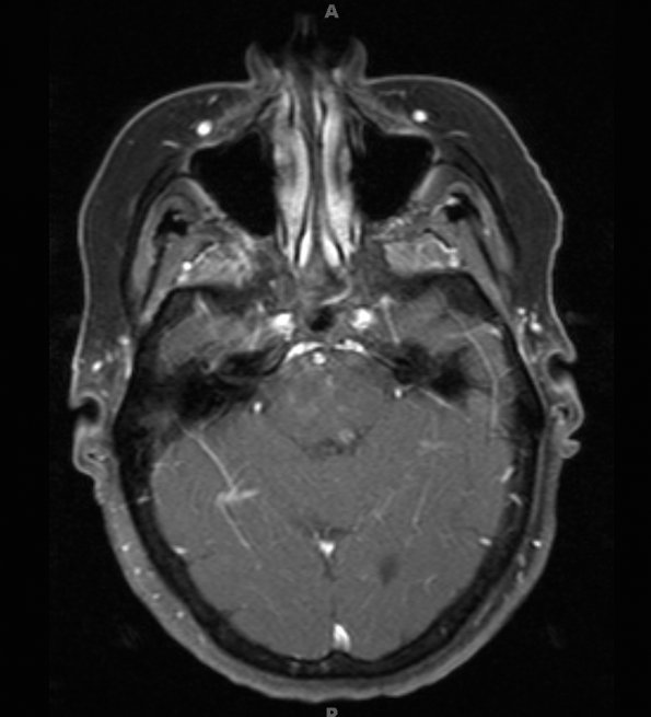 12A1 Cavernomas, familial (Case 12) T1 TRA FC FS with contrast 3 - Copy