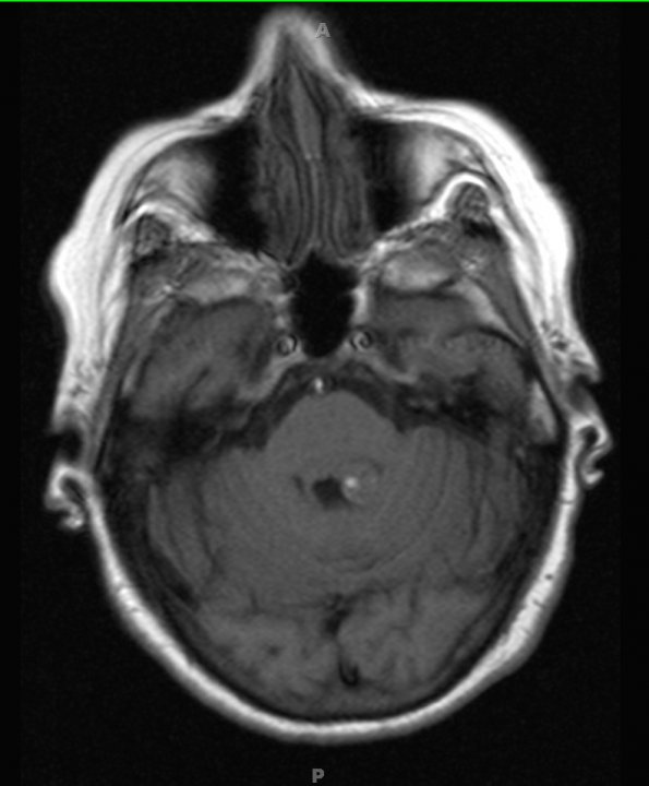 12A2 Multiple cavernoma2 (Case 12) T1 without contrast - Copy