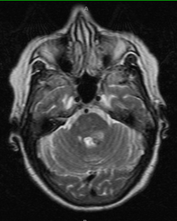 12A3 Multiple cavernoma2 (Case 12) T2 without contrast - Copy