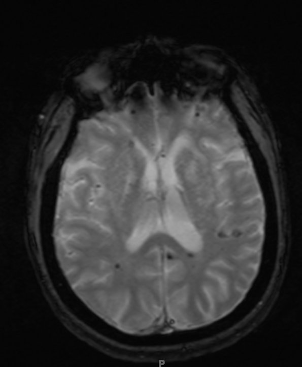 12A4 Cavernomas, familial (Case 12) T2 FL2D tra hemo no contrast 4 - Copy (2)