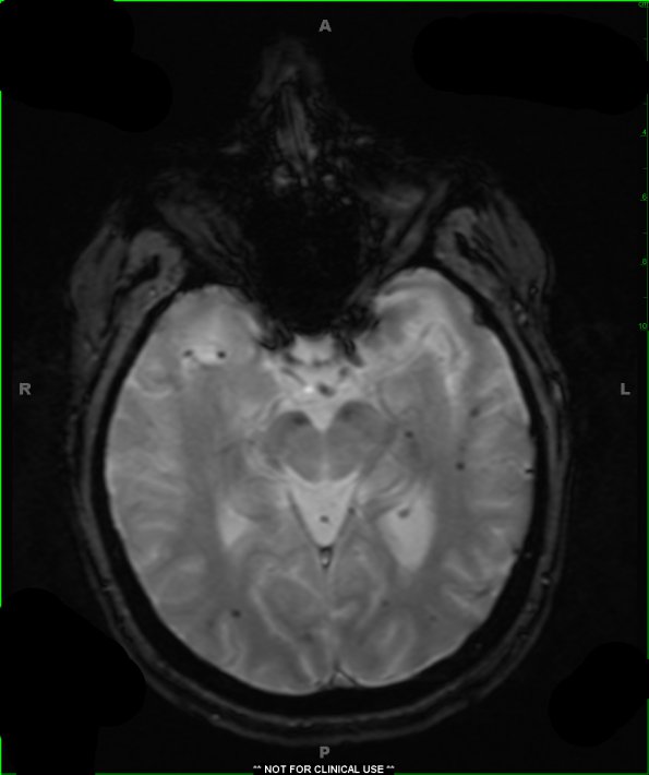 12A5 Cavernous Malformations, multiple, familial (Case 12) T2 FL2D TRA HEMO 3 - Copy