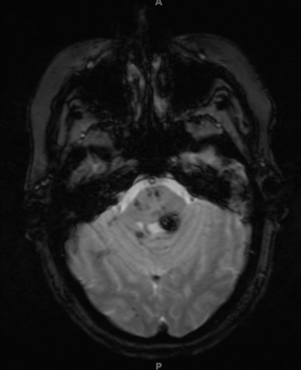 12A6 Cavernomas, familial (Case 12) T2 FL2D tra hemo pat2 no contrast 1 - Copy