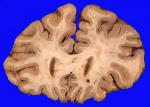 12B1 Cavernoma, multiple, familial (Case 12) 6