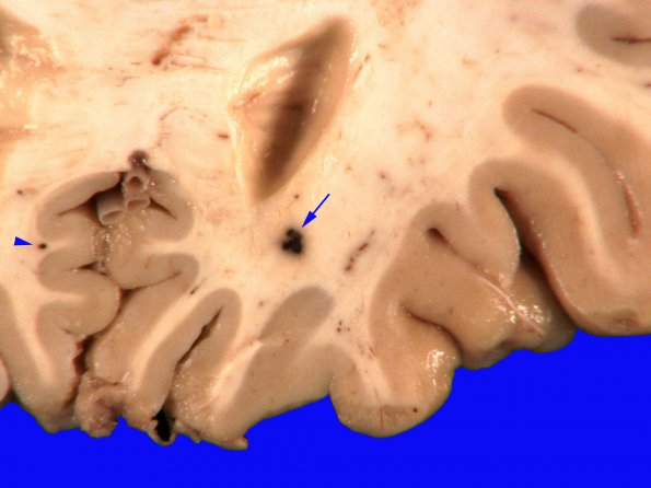 12B2 Cavernoma, multiple, familial (Case 12) 6A copy