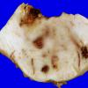 12B3 Cavernoma, multiple, familial (Case 12) 3A