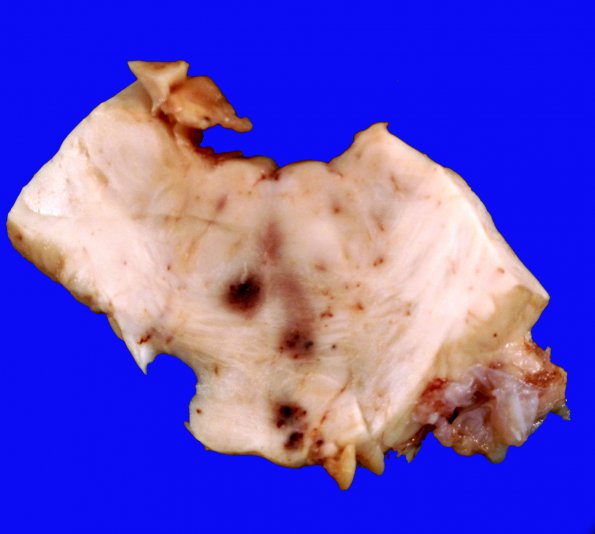 12B5 Cavernoma, multiple, familial (Case 12) 4
